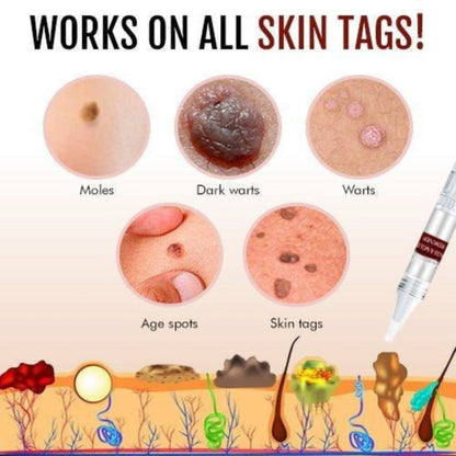 Effective Skin Tag and Mole Removal