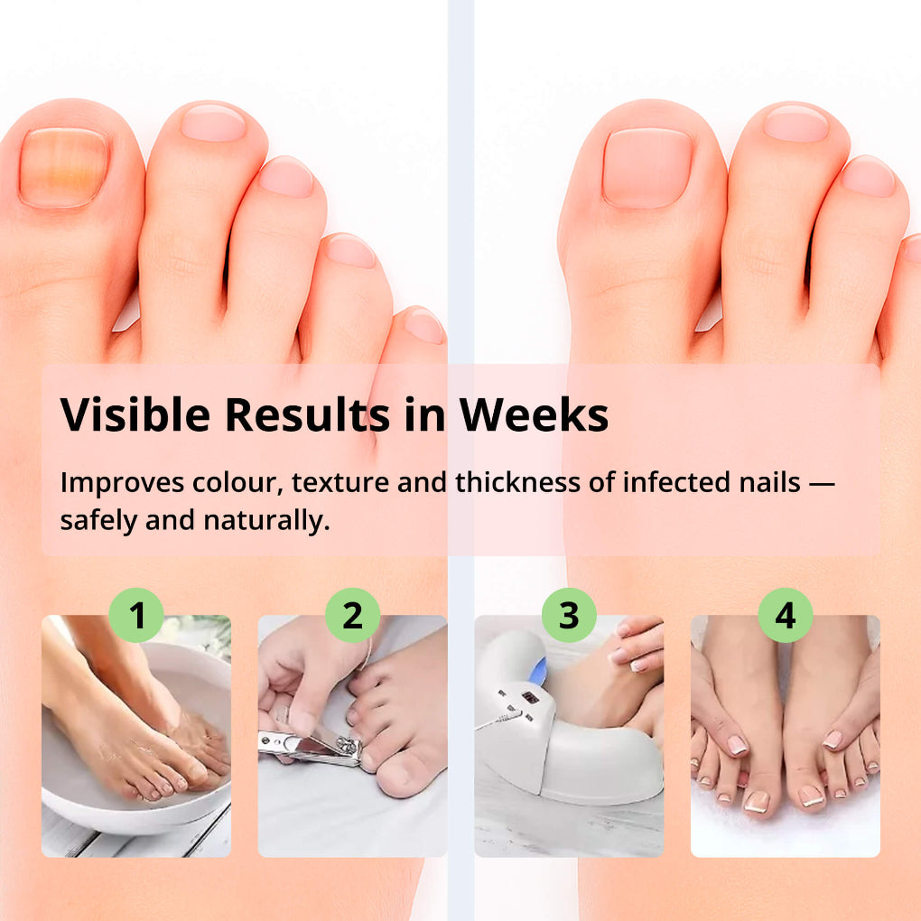 Fast Nail Fungus Treatment Device