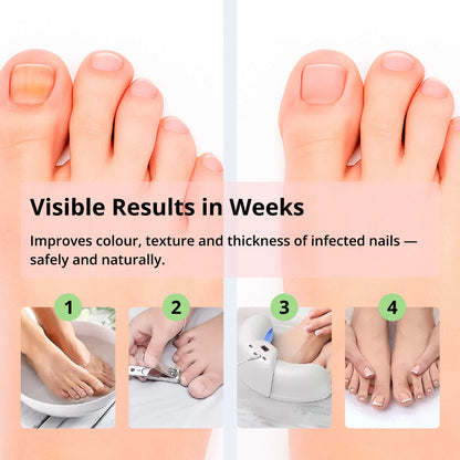 Fast Nail Fungus Treatment Device
