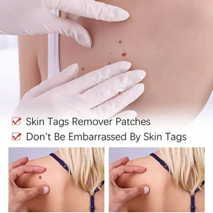 Effective Skin Tag and Mole Removal