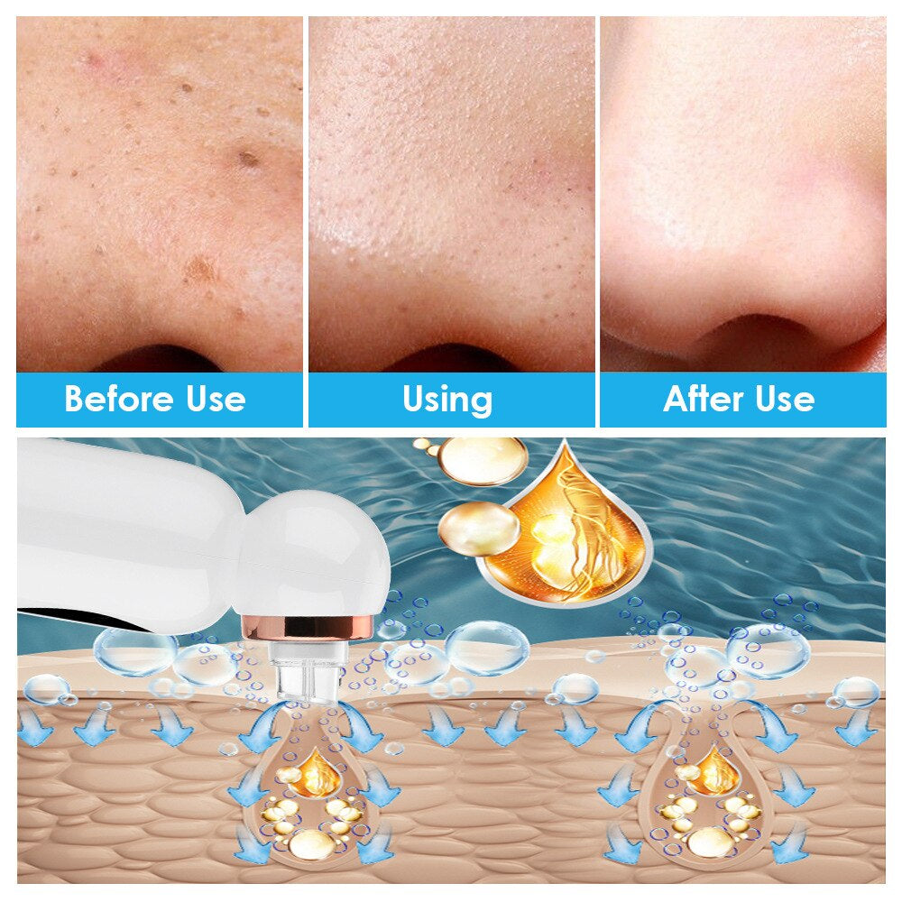 Mee-eter Remover and Hydrodermabrasion - HydraGlow-Nora Luxe