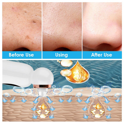 Mee-eter Remover and Hydrodermabrasion - HydraGlow-Nora Luxe